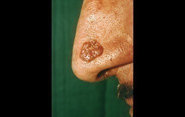 Pigmented Basal Cell Carcinoma