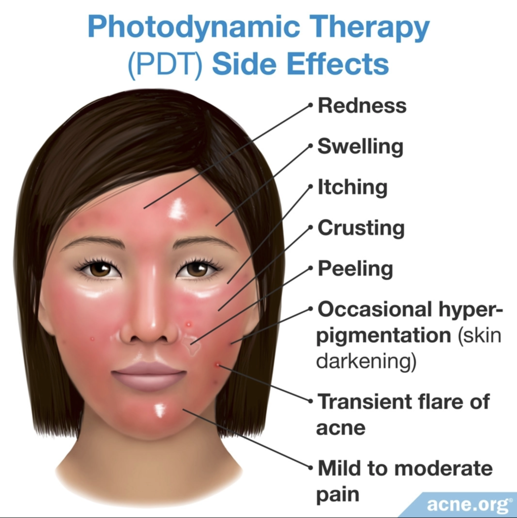 Bita Bagheri Photodynamic Therapy