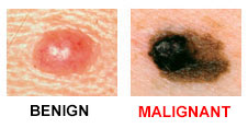 Dr. Bita Bagheri Orange County Dermatology melanoma treatment