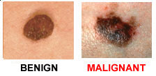 Dr. Bita Bagheri Orange County Dermatology melanoma treatment