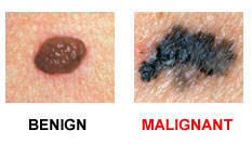 Dr. Bita Bagheri Orange County Dermatology melanoma treatment