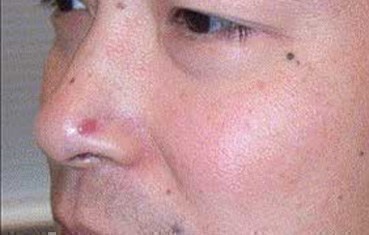 nodular-basal-cell-carcinoma-slide2
