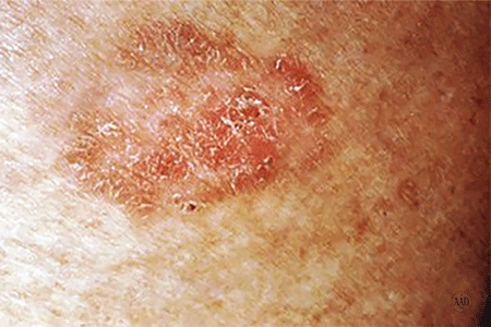 Dr. Bita Bagheri Orange County Dermatology squamous cell carcinoma